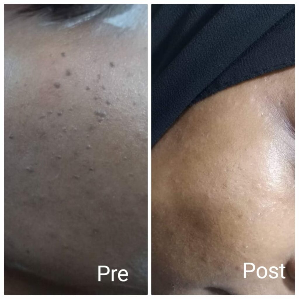 Removing spots and appendages while smoothing the skin after fractional laser sessions for the face